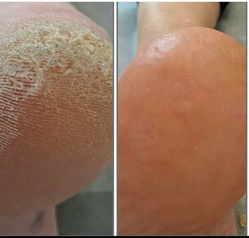 Wygładzenie modzeli i zrogowaceń przed i po opracowaniu podologicznym