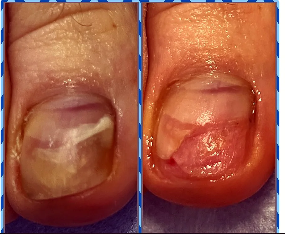 Rekonstrukcja płytki paznokcia przed i po terapii podologicznej