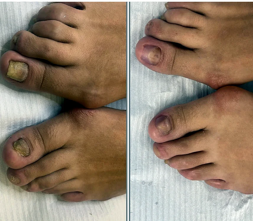 Regeneracja paznokcia stopy przed i po terapii podologicznej